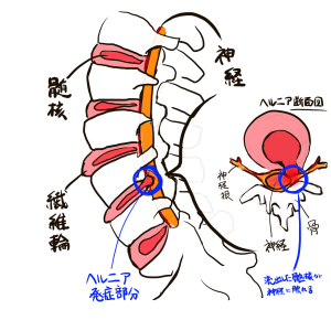 椎間板の中にある髄核が背骨に沿って通る神経に当たると、腰に激しい痛みを覚えるようになります。